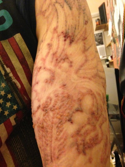 Half Sleeve Tattoo Removal - Nottingham, MD - Tattoo Removal review ...
