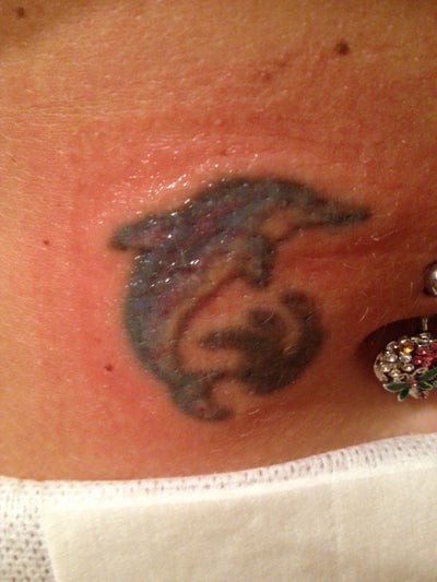 Burnt by laser Tattoo removal: Is this normal? (Photo) Doctor Answers ...