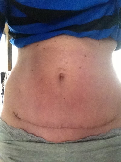 before and after mini tummy tuck recovery