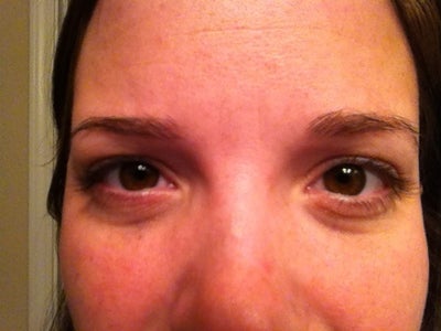 What can I do to treat my purple circles and puffy under eyes. Is ... What can I do to treat my purple circles and puffy under eyes. Is ...