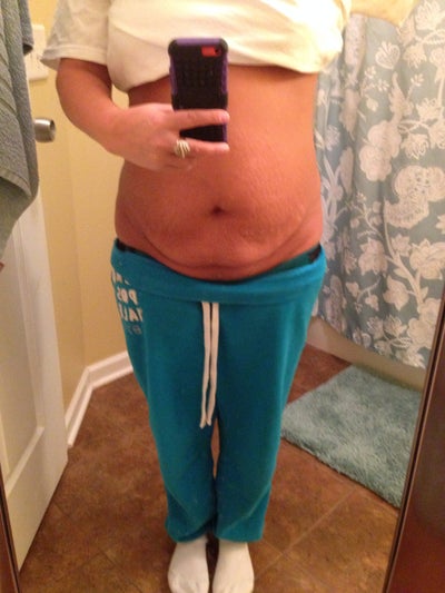 Tummy Tuck with Muscle Tightening/ Lipo to Back Rochester 