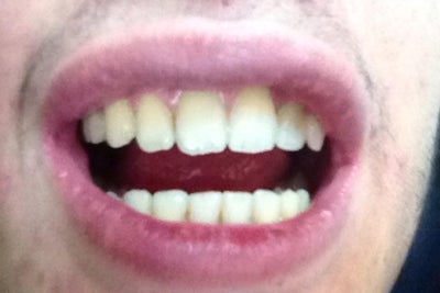 teeth moving braces front forward affects mouth fixed without two