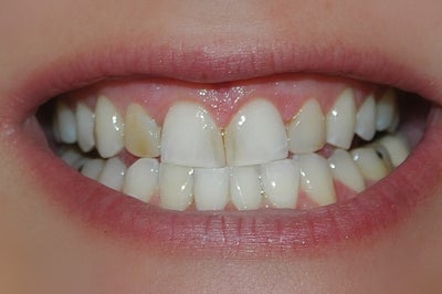 zoom teeth whitening austin