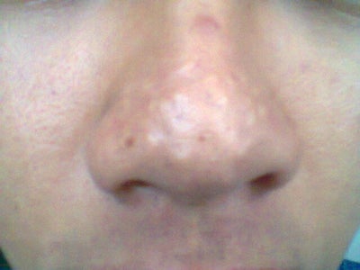 Best Treatment for Acne scars on the nose and large pores Best Treatment for Acne scars on the nose and large pores