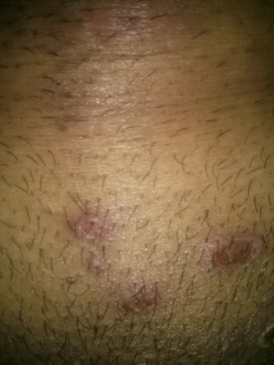 Small sores on the head of the penis
