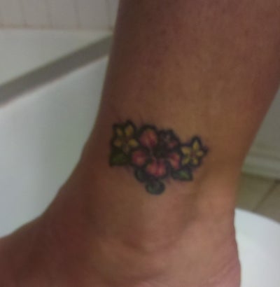 would laser help with removal of tattoo scar photo would laser help with removal of tattoo scar photo