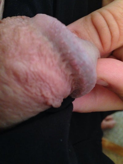 Penis Head Swelling 34