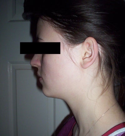 Chin liposuction uk reviews tripadvisor