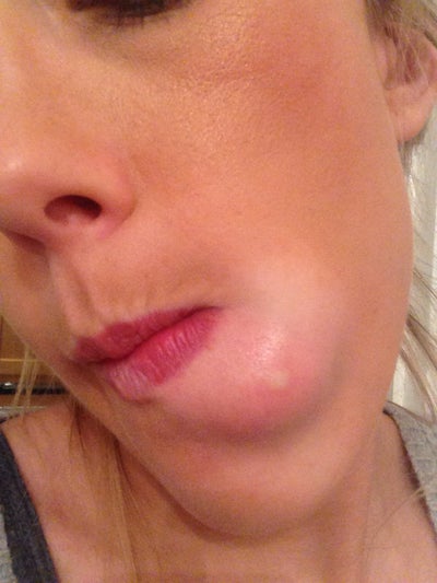 Ball growth under facial skin Vod adult lesbain video