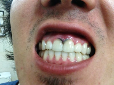 gums teeth grey whitening professional tips ago