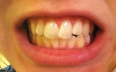 teeth crowded overlap dentist