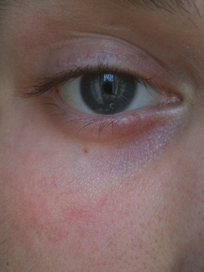 Dark circles under eyes - Mayo Clinic