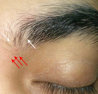 Eyebrow Hair Loss, Flaking and Scabbing, Is this a Thyroid ...