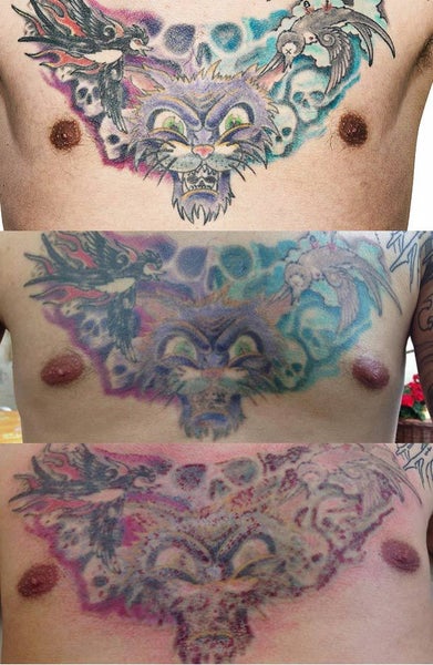 Tattoo Removal of a Full Sleeve and a Lowerleg Sleeve / Chest, Stomach ...