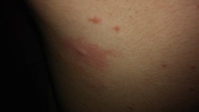 I have a rash spreading over my body. It's itchy and ...