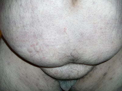 Fat Above Penis 102