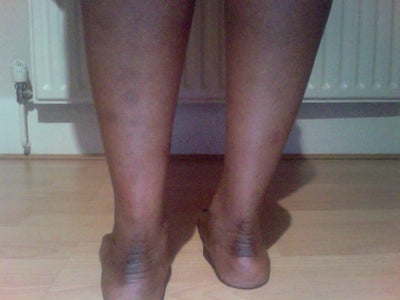 How Can I Get Rid Of The Spots Scars And Hyperpigmentation On My Legs 