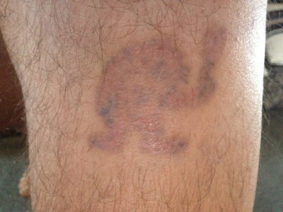 Light Brown Tattoo turning red? (photo) Doctor Answers, Tips