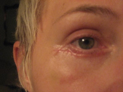 skin scars when healed uneven stitch healing underneath taken stitches months