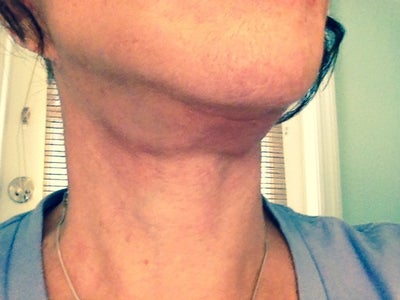 neck lift away go under lumps months