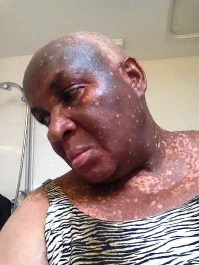My Skin Disaster Bleaching Creams? (photo) Doctor Answers, Tips