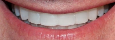 invisalign after months bonding columbus oh realself finishing done had started results