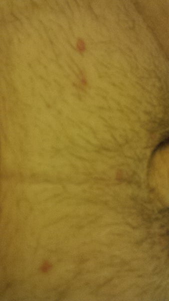 Red Bumps At Base Of Penis 48