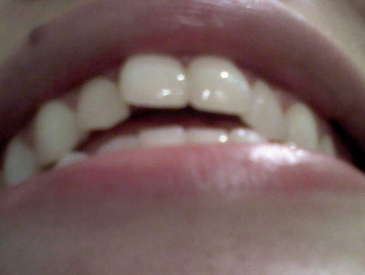 shifted teeth