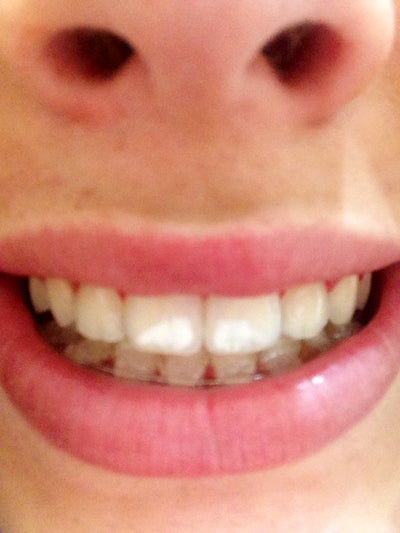gum spots rid cheeks teeth recounting need woodlands tx ago
