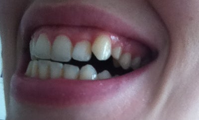 Orthodontics to Fix Single Protruding Tooth? (photo) Dentist Answers, Tips