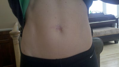 No Belly Button After Hernia Repair? (photo) Doctor ...