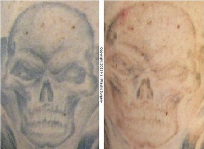 PicoSure Tattoo Removal After 1 Treatment photo from Jeffrey W. Hall ...
