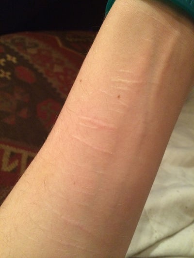 What can I do about my scars on my arms. Should I get ...