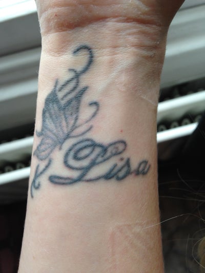 Wrist Tattoo Removal - London, GB - Tattoo Removal review - RealSelf