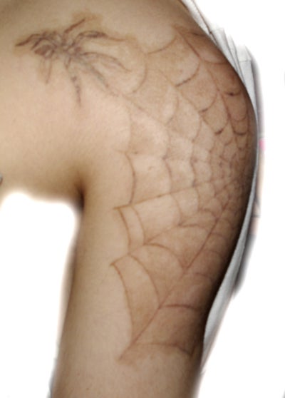 brown spots on skin after laser photo doctor answers tips brown spots on skin after laser photo doctor answers tips