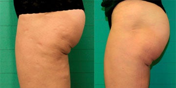 Exilis Before and After Photos