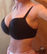 Scarless Breast Lift