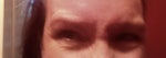 Has anyone experienced enlarged eyebrow muscles as a result of horribly botched botox job?