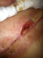 Did anyone have any problems with the stitches coming out?