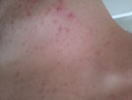 nair acne rash