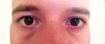 Black marks on tear troughs 6 months after Juvederm