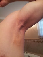 Has anyone experienced scar tissue after Miradry?