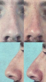 Septo-Rhinoplasty Performed in June 2013, Results Are Less Than Desirable. Still Crooked, and Have a Bump. Any Options? (photo)