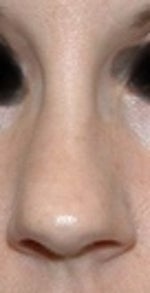 Can't straighten my nose?