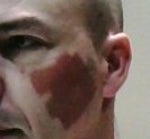 Red mark left by fractional laser