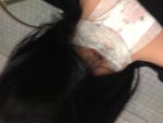 Aftercare tattoo removal using q switch laser