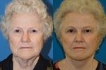 16 Things I Wish I Knew Before Getting a Facelift
