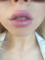 Will a lip lift make me more attractive