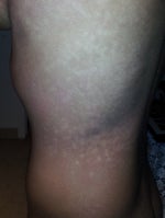 I have cream spots/ patches (hypopigmentation) on my upper body that will not go away. What is my diagnosis (photos attached)?