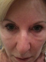 Bags under eyes caused by Selphyl